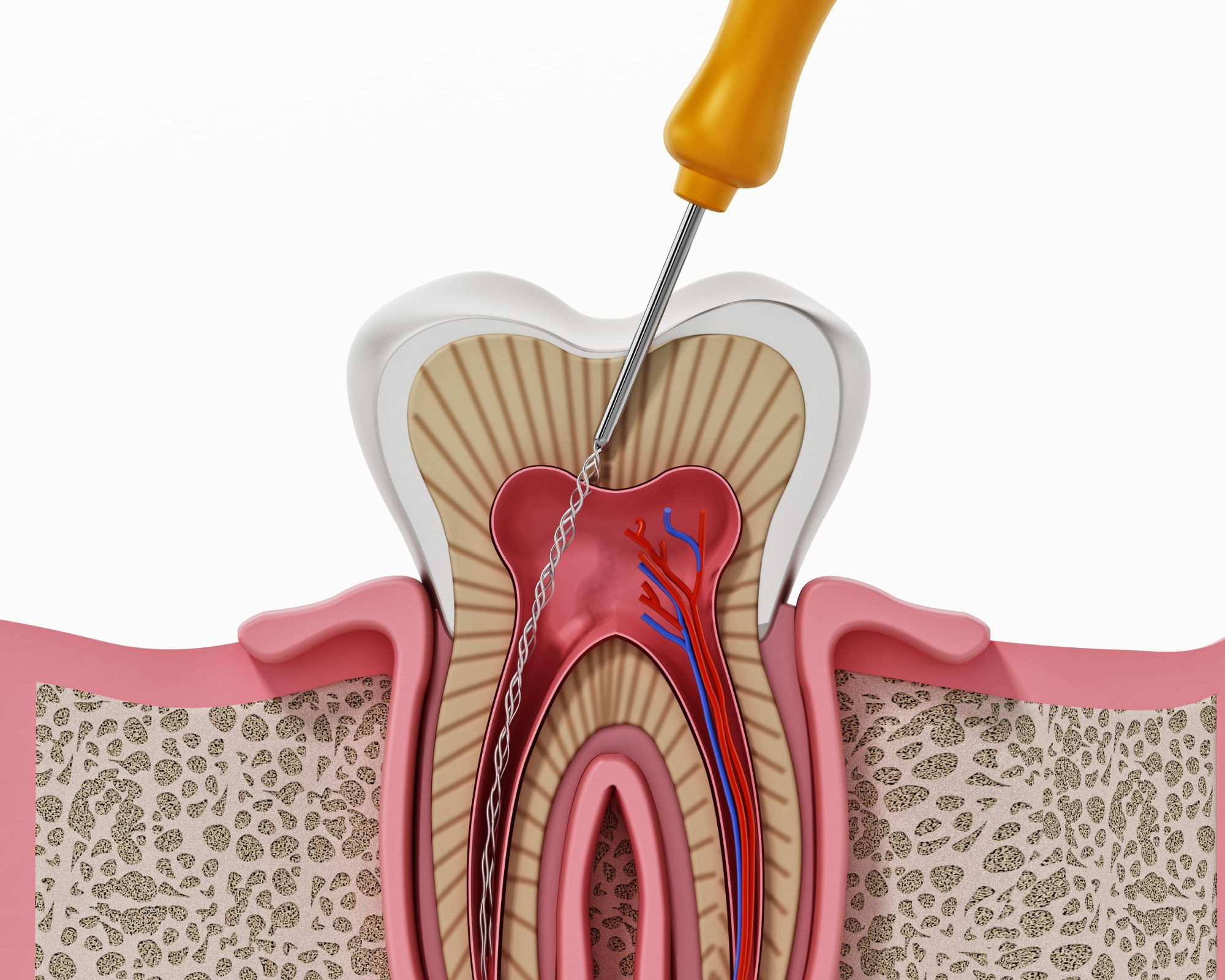 Schéma explicatif d'une intervention d'un endodontiste