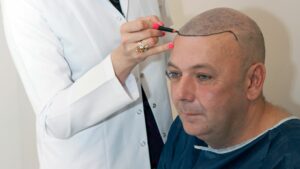 Une procédure de greffe de cheveux pour hommes